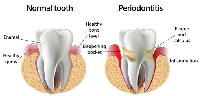 Westside Dentistry gum disease