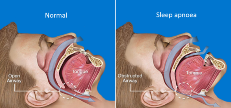 Oral Appliance Therapy For Sleep Apnoea Westside Dentistry